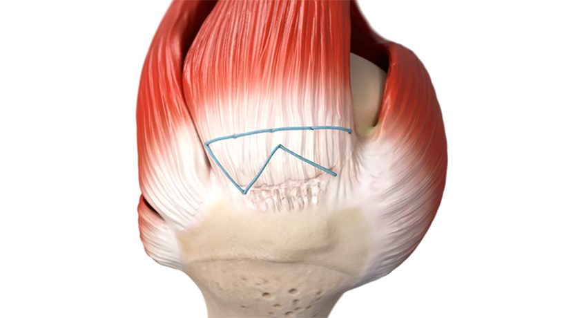 Integrity Orthopaedics Tendon Seam