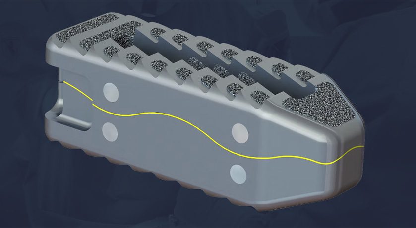 Spark Spine EMP Implant