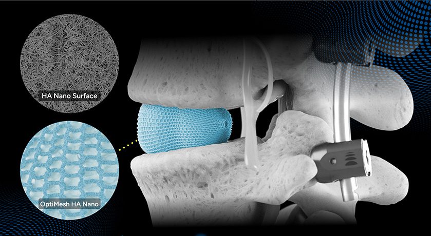 Spineology OptiMesh HA Nano