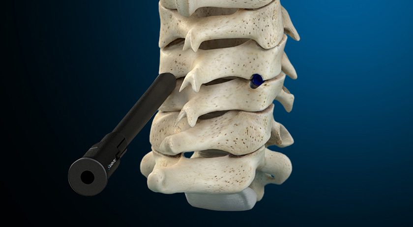 SurGenTec ION-C Facet Fixation