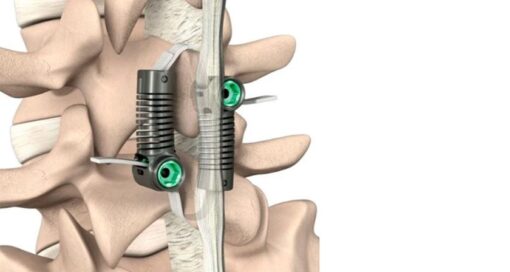 Empirical Spine Limiflex