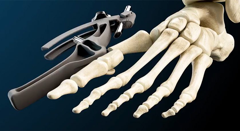 GLW Medical Sabre Bunion Correction