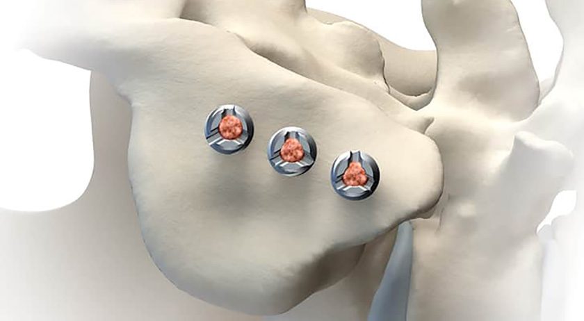 Genesys Spine SIros Lateral SI Joint Fusion