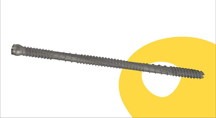 SI-BONE iFuse TORQ TNT