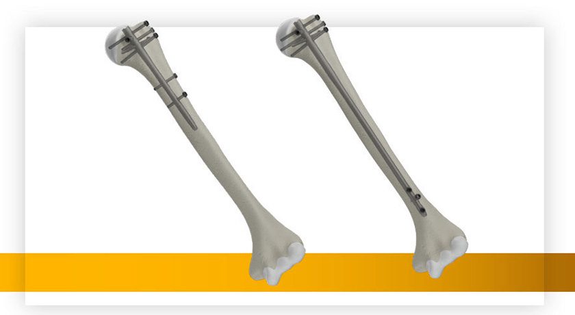 Stryker T2 Alpha Humerus Nail
