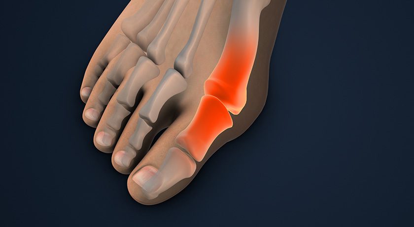 Launch of OSSIOfiber Minimally Invasive All-natural Bunion Correction