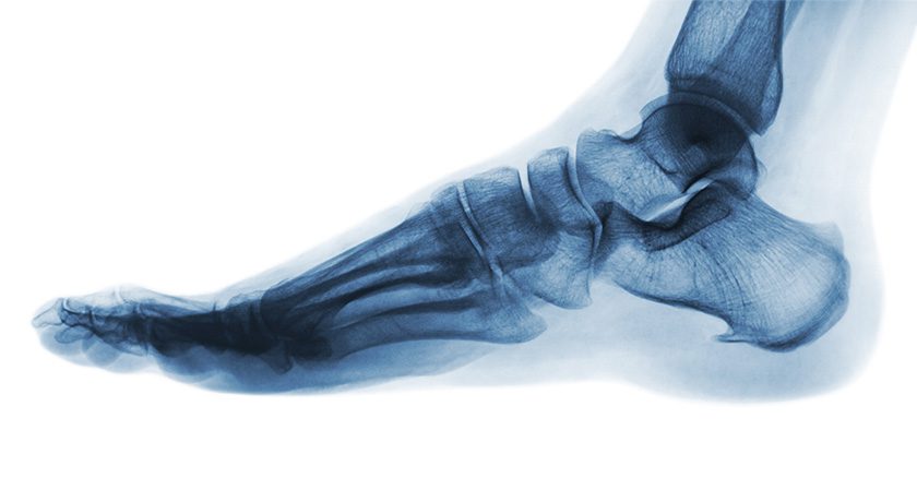 MiRus Receives FDA 510(k) Clearance for IO Expandable Wedge Osteotomy System