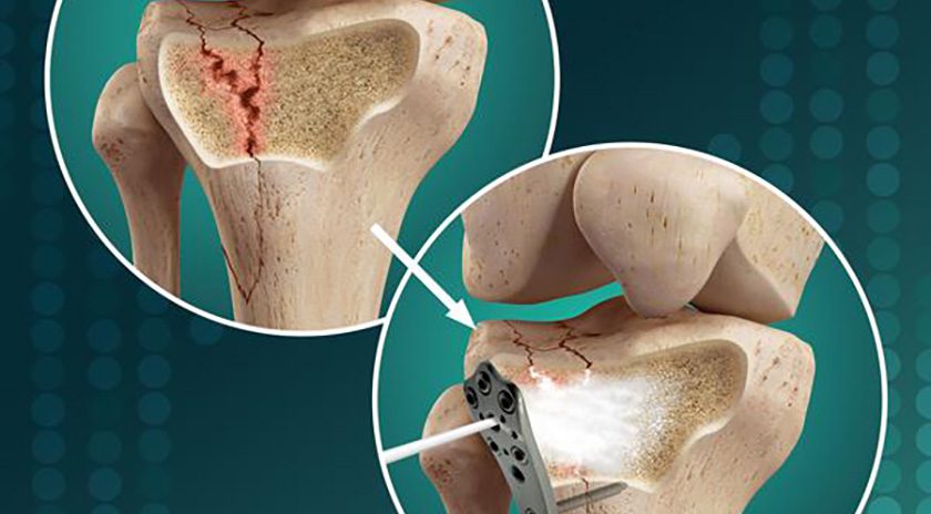 Biomimetic Innovations OsStic Injectable Synthetic BVF