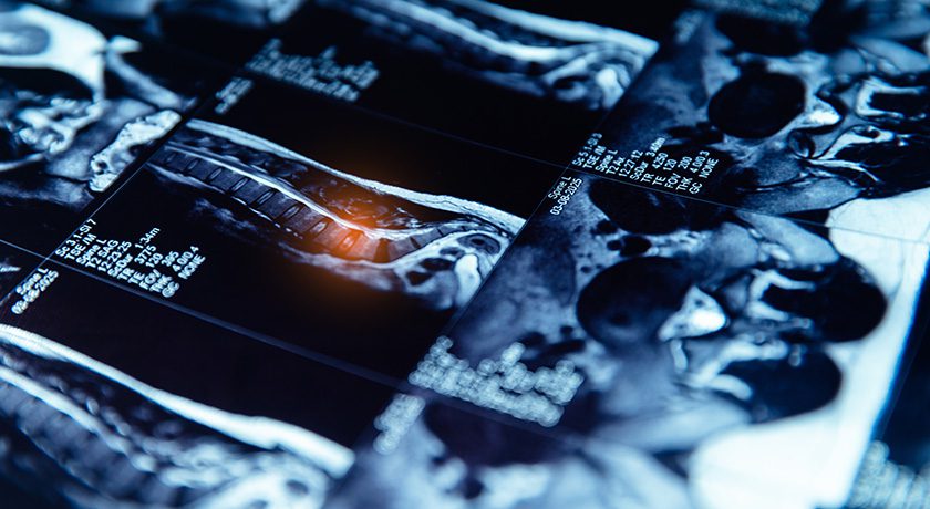 BioRestorative Therapies Reports Positive Phase 2 Blinded Data for BRTX-100