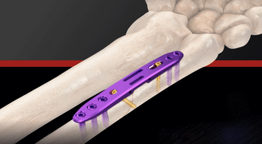 GMReis Ulna Shortening Plate