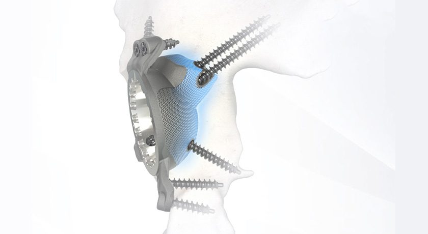 Medacta MyImplant Hip