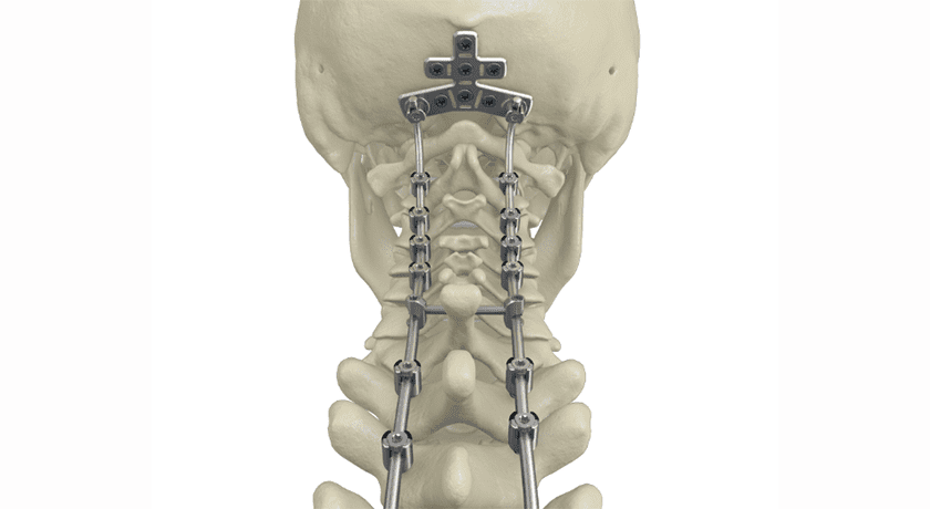 VB Spine Launches in the Netherlands and Belgium