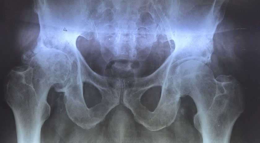 hip and pelvis x-rays