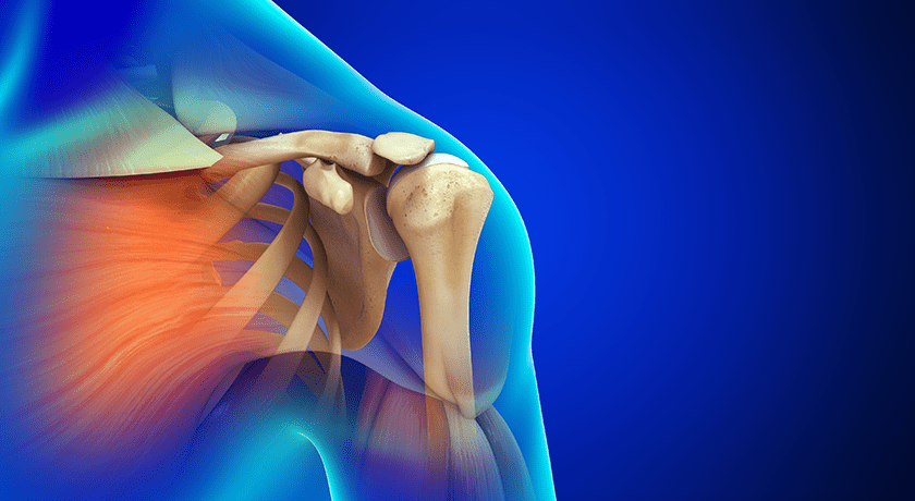 Shoulder Innovations Initiates Full Commercial Launch of the InSet I-135RFX Humeral Stem