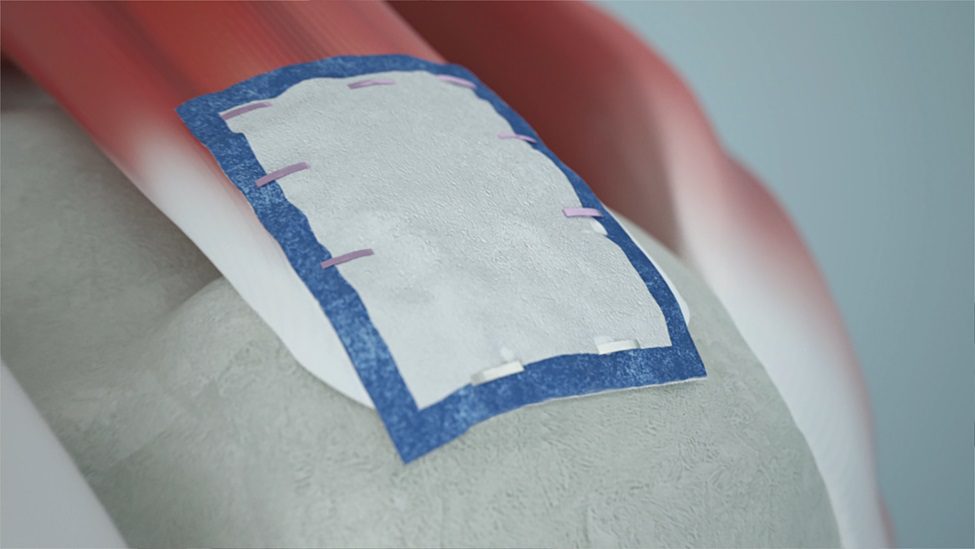 Smith+Nephew REGENETEN