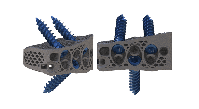 DeGen Medical Patient-Specific Implant