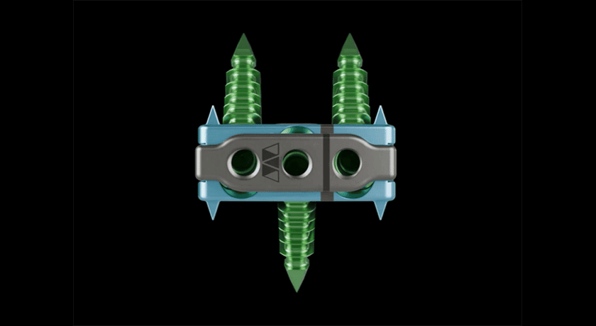 Elevation Spine Saber C Implant
