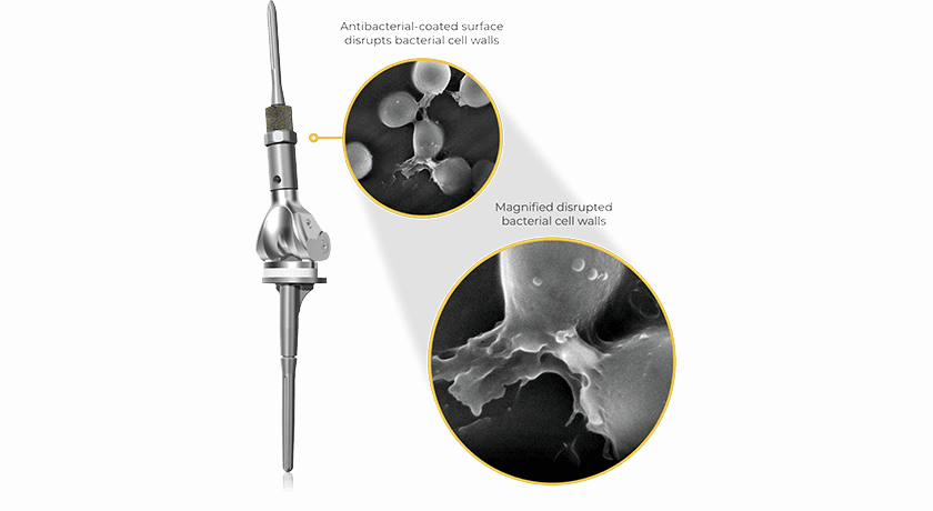 Onkos Surgical ELEOS implants with NanoCept