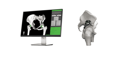 Replasia Hip Preservation Technology