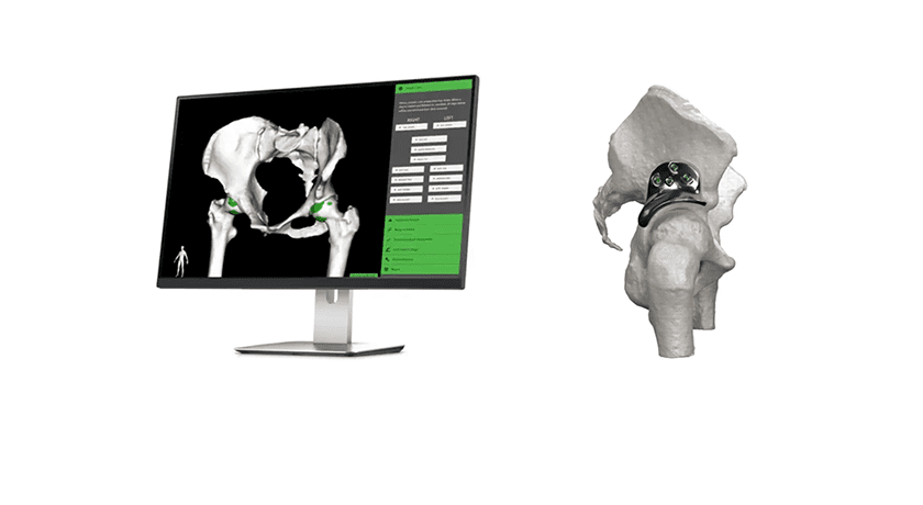Replasia Hip Preservation Technology