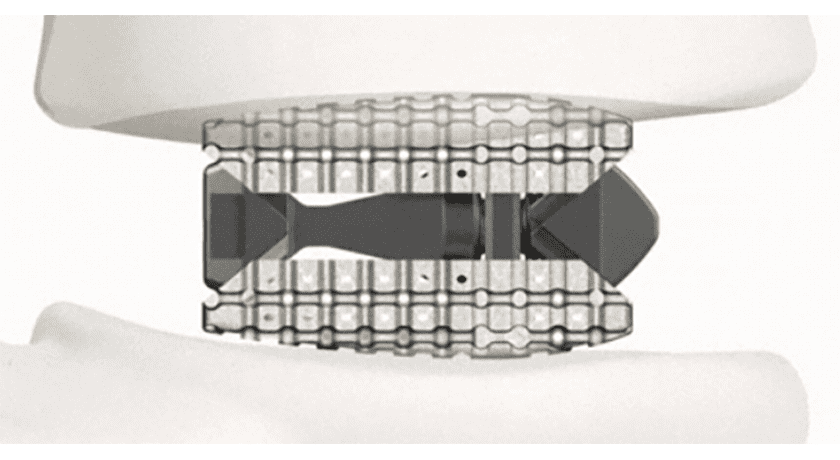 Xenix Medical Lux Expandable Lumbar Interbody Fusion