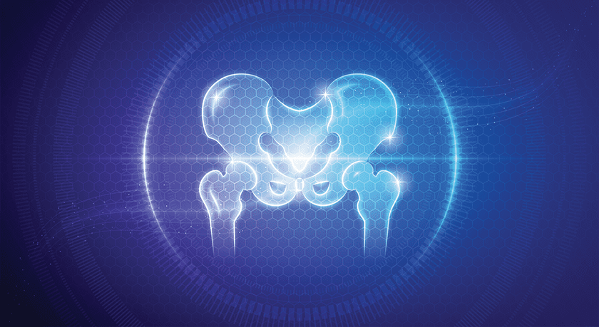 Bio-Gate: Update on the HIPrevision clinical trial for HyProtect-coated hip revision implants