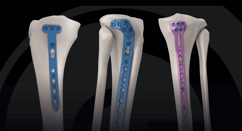 GMReis VersaLock Tibial Plateau Plating