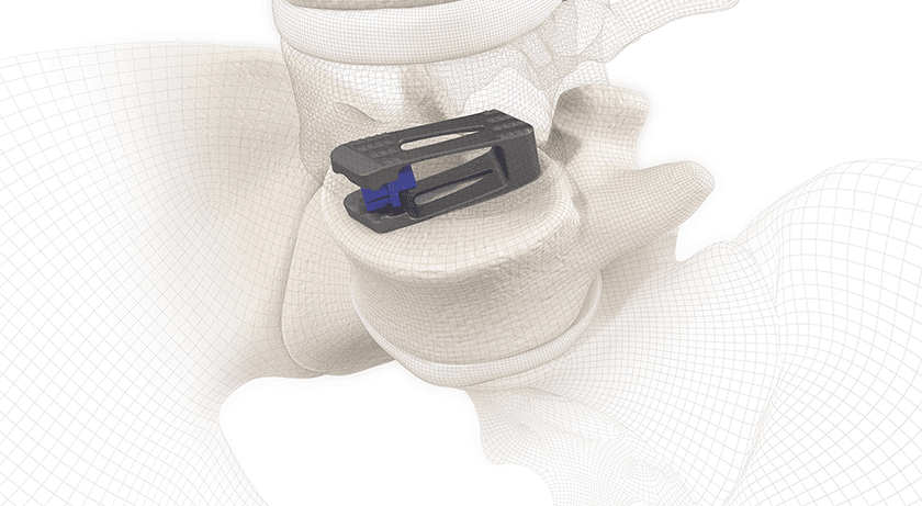 SIGNUS USA VertaConnect Expandable Lumbar Fusion Spine Implant