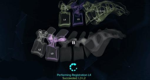 Augmedics CT-Fluoro Technology