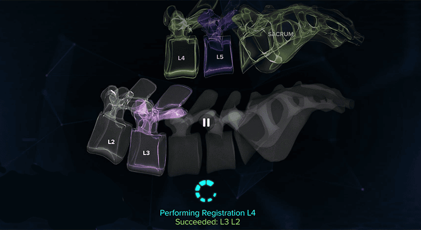 Augmedics CT-Fluoro Technology