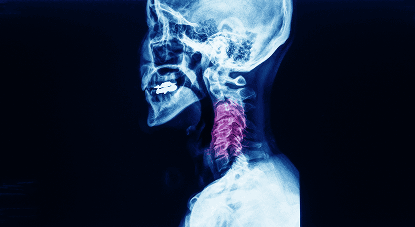 Elevation Spine Receives FDA 510(k) Clearance for Saber-C AVIA