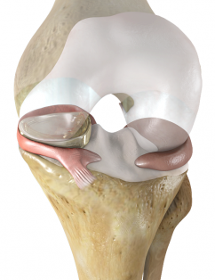 Active Implants NuSurface