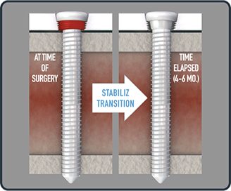 StabilizOrtho SPL Screw Transition