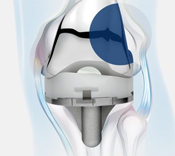 MicroPort Medial Pivot Knee