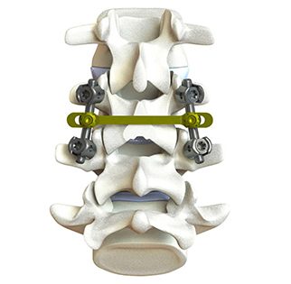 KAHTNU Talkeetna Pedicle Screw