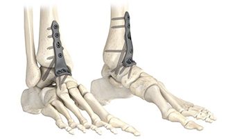 Stryker AxSOS 3 Ankle Fusion System