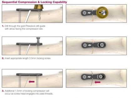 Novastep Presslock Plate Insertion Steps