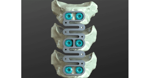 ReVivo Medical Spinal Plates