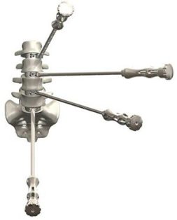 NovApproach Spine's OneLIF device offers surgeons one cage that supports multiple approaches to the patient's lumbar spine