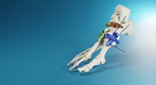 MedCAD AccuStride