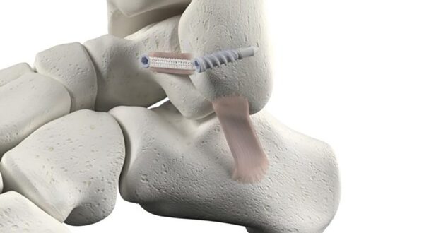 Medline UNITE Synthetic Ligament Augmentation