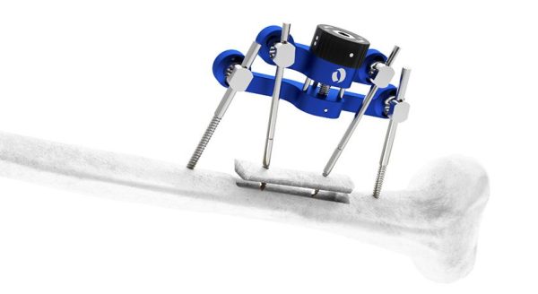 Orthofix TrueLok Elevate Transverse Bone Transport System