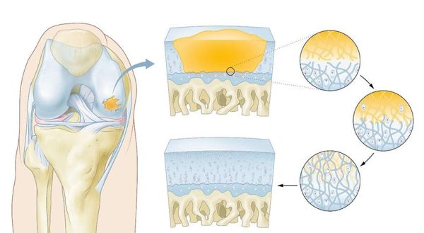 Hy2Care CartRevive Hydrogel Implant