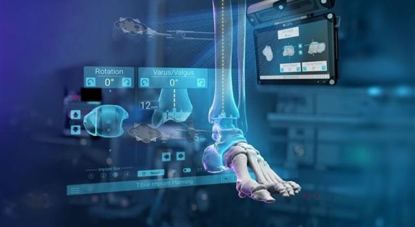 Exactech GPS Ankle Navigation