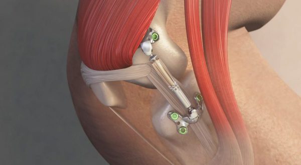 Moximed MISHA Knee System