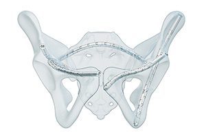 CurvaFix Implants in Pelvis