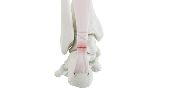 Medline Industries Forcecord Achilles Repair