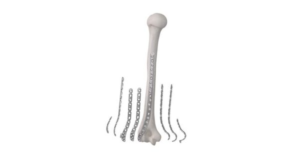 Globus Medical ANTHEM Elbow Fracture System