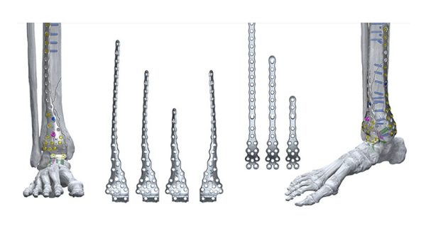 The company announced the full commercial launch of the Gorilla Pilon Fusion Plating System and the Phantom TTC Trauma Nail.