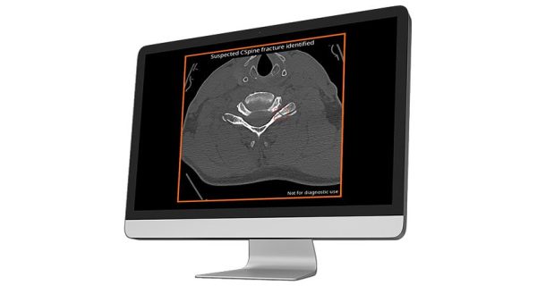 Avicenna.AI Launches AVI Platform For Medical Imaging AI